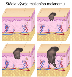 vývojová_stádia_maligního_melanomu