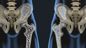 Osteoporóza