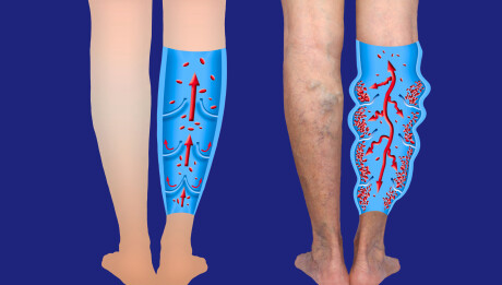 Varicose veins on a female senior legs. The structure of normal and varicose veins.