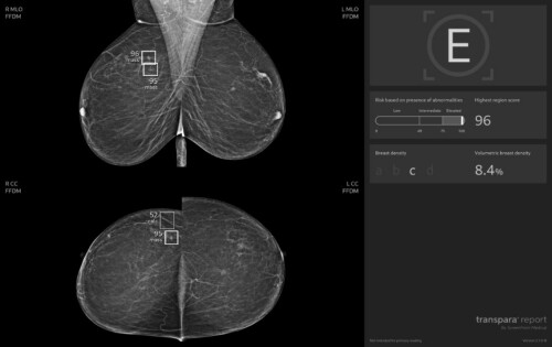 Mamografie_s_AI_-_Ukazka_snimku