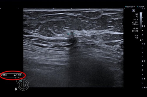 Mamografie_s_AI_-_Ukazka_snimku